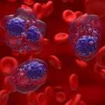 Një analizë e thjeshtë gjaku mund të ndihmojë në diagnostikimin e hershëm të mielomës së shumëfishtë