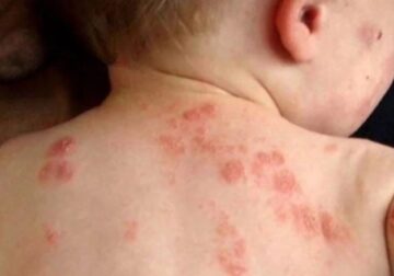 S’ka shpërthim fruthi në Shqipëri, i vetmi rast një muaj më parë