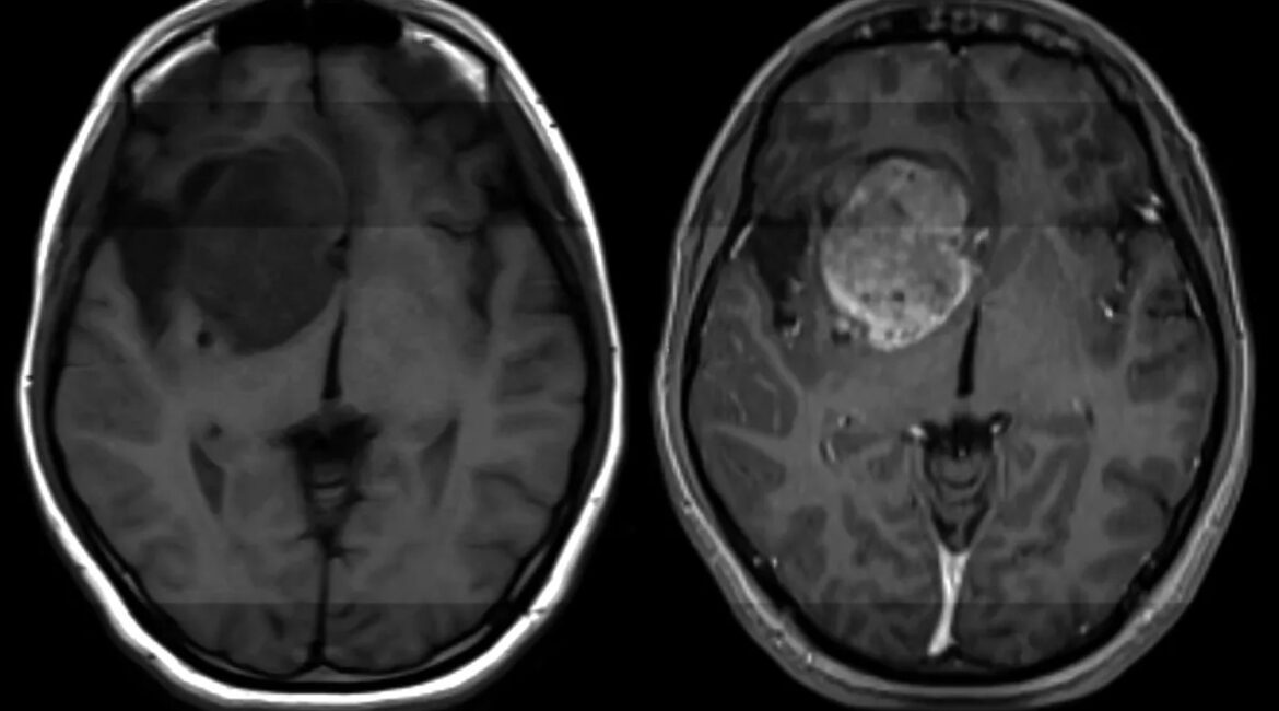 Ky kancer vdekjeprurës i trurit ende s’ka shërim, shkencëtarët bëjnë zbulimin premtues