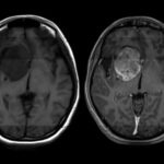 Ky kancer vdekjeprurës i trurit ende s’ka shërim, shkencëtarët bëjnë zbulimin premtues